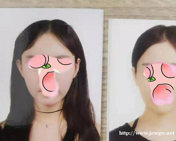 左图为术前，右图为术后（图片由受访者提供）