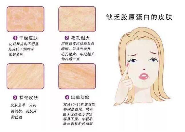 人体缺乏胶原蛋白会有什么症状表现,七老燕窝胶原蛋白 人体缺乏胶原蛋白会有什么症状表现,七老燕窝胶原蛋白