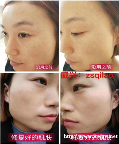 脸上斑点如何去除淡化要使用什么产品去掉 脸上斑点如何去除淡化要使用什么产品去掉