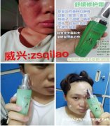 七老舒缓霜，皮肤过敏怎么快速修复红痒肿痛