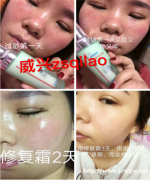 宝宝湿疹怎样快速止痒消除，七老舒缓霜