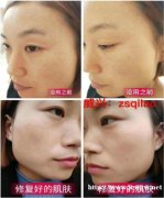 脸上斑点如何去除淡化要使用什么产品去掉