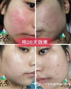屏障受损要怎么修复，肌肤屏障受损之后皮肤有什么表现